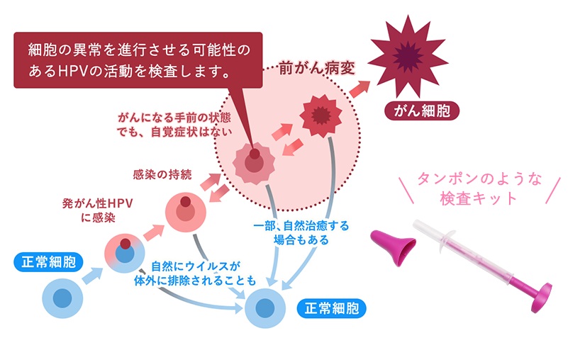 タンポンのような検査キットで、細胞の異常を進行させる可能性のあるHPVの活動を検査します。