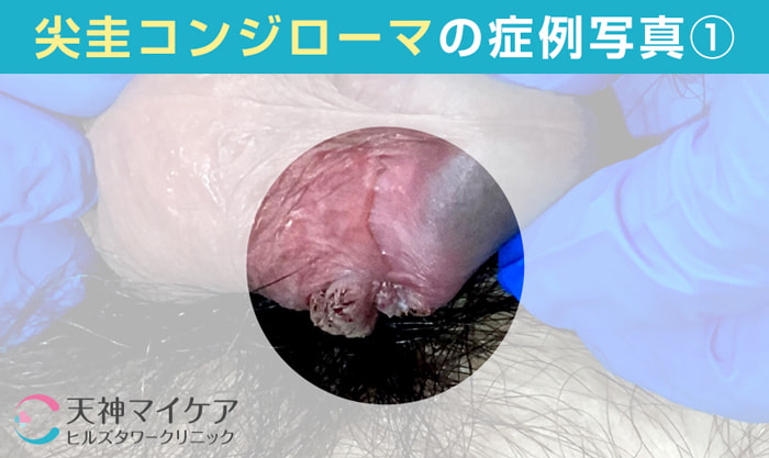 男性の尖圭コンジローマ症例画像1