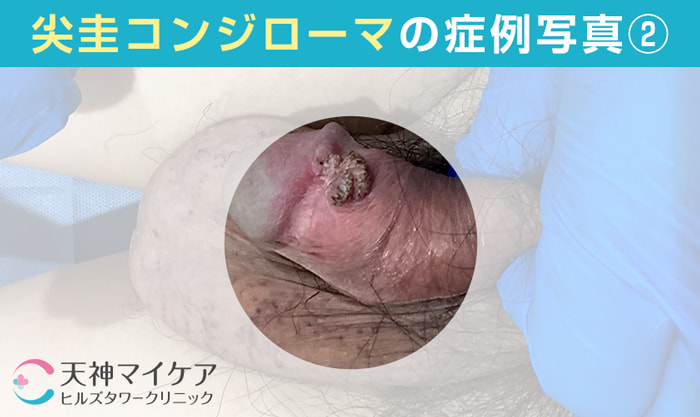 男性の尖圭コンジローマ症例画像2