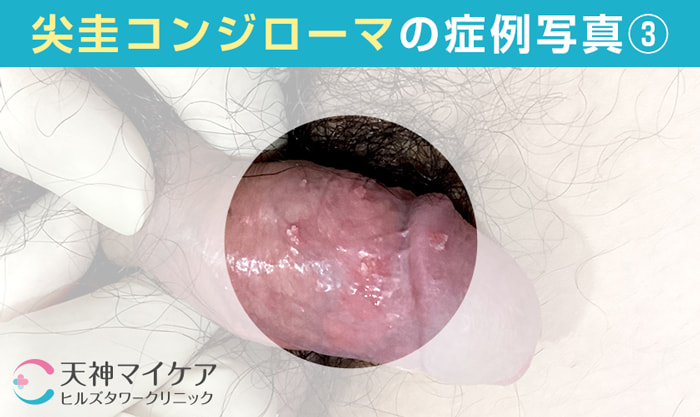 男性の尖圭コンジローマ症例画像3