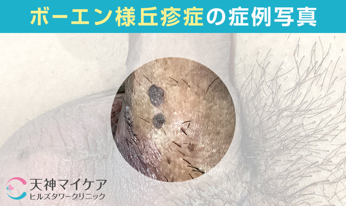 男性のボーエン様丘疹症の症例画像