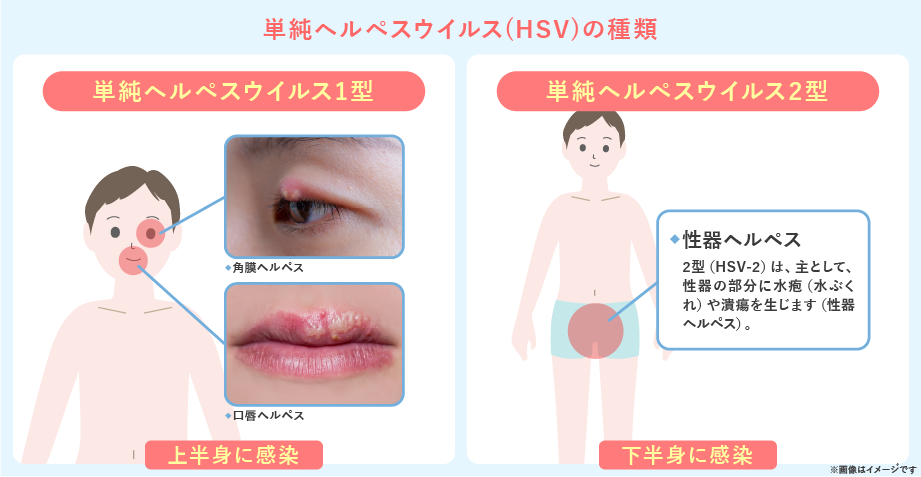 口唇ヘルペスに対する追加の家庭療法