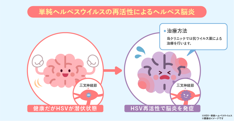 単純ヘルペスウイルスの再活性によるヘルペス脳炎