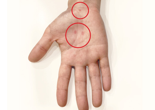 梅毒の症状が手のひらに出ている写真
