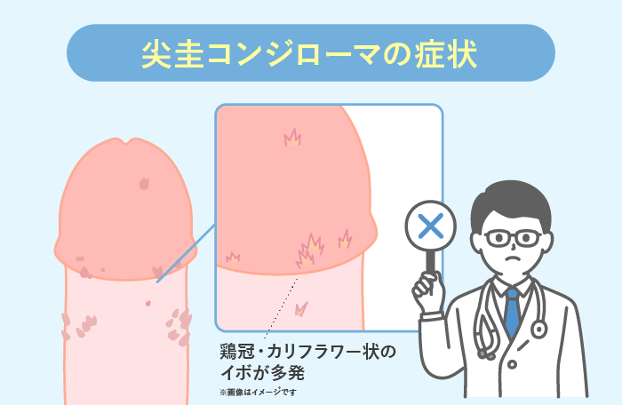 尖圭コンジローマの症状：鶏冠・カリフラワー状の イボが多発※画像はイメージです