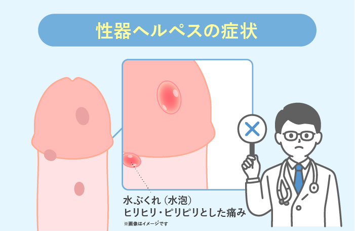 性器ヘルペスの症状：水ぶくれ (水泡) ヒリヒリピリピリとした痛み※画像はイメージです