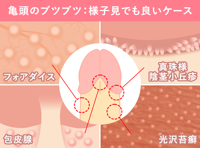 危険な疾患ではない亀頭のブツブツ