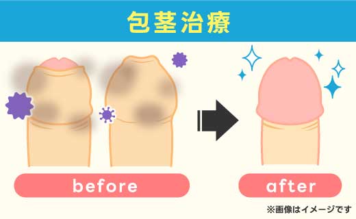 包茎治療すると清潔に保てるイメージ