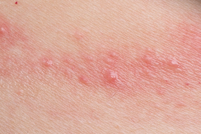 接触性皮膚炎により、臀部の皮膚が赤く炎症している写真