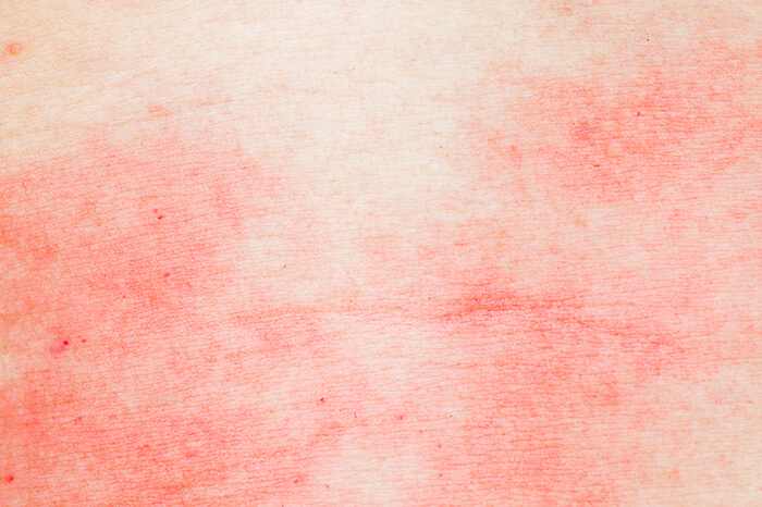 アトピー性皮膚炎により、臀部の皮膚が赤く炎症している写真