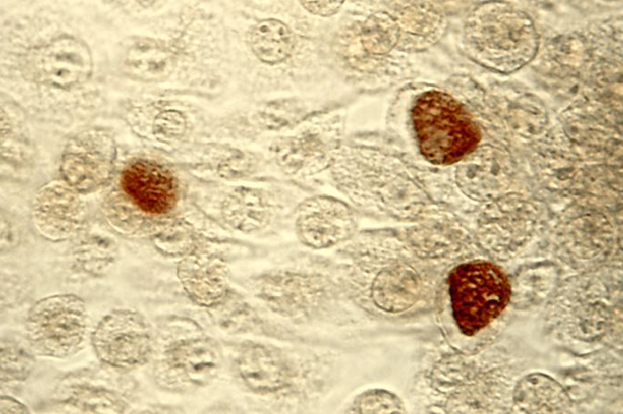 McCoy細胞培養におけるクラミジア・トラコマティスの褐色封入体