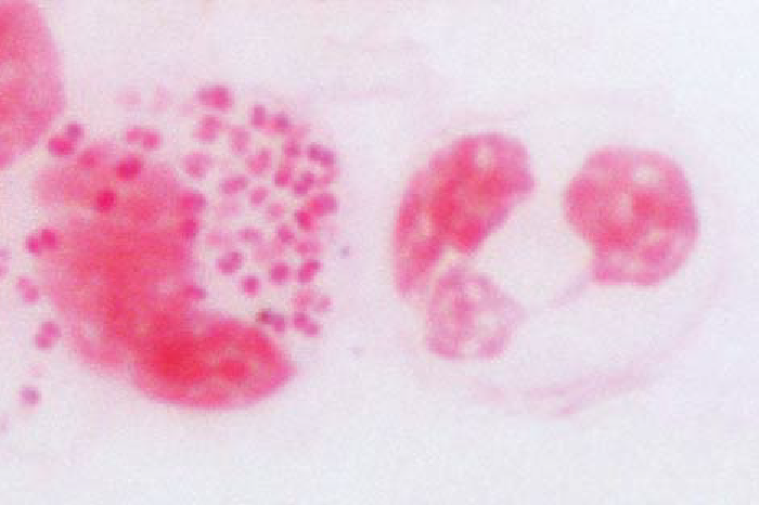 男性尿道炎患者からの尿道分泌物の塗抹標本（グラム染色）